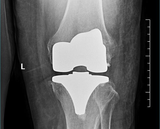 膝关节置换手术后，更应该关注的是康复