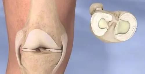 外侧半月板损伤