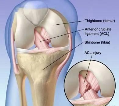 前十字韧带损伤