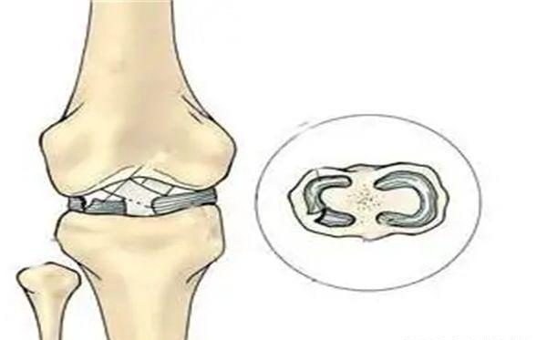 先天性半月板畸形要怎么办？及时去医院进行治疗