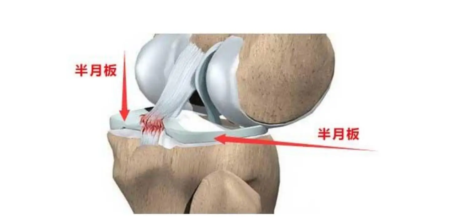 半月板损伤后不能做的3个动作