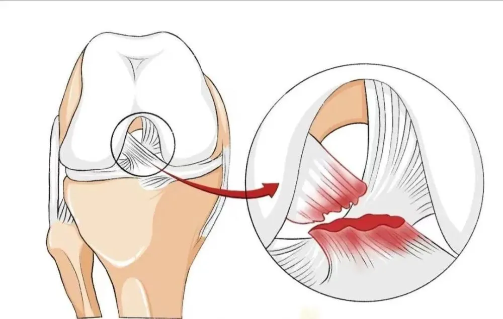 前交叉韧带（ACL）损伤愈合周期