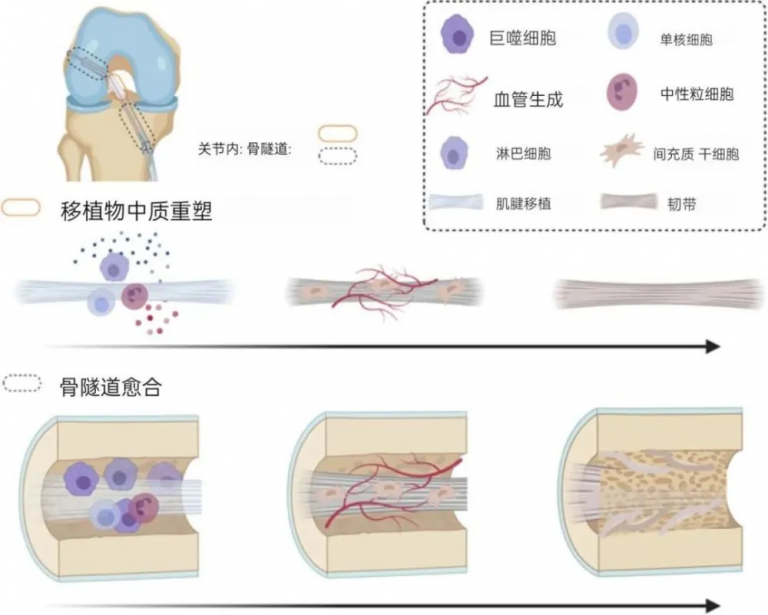 前交叉韧带(ACL)损伤愈合周期 | 南京复见运动医学康复诊所
