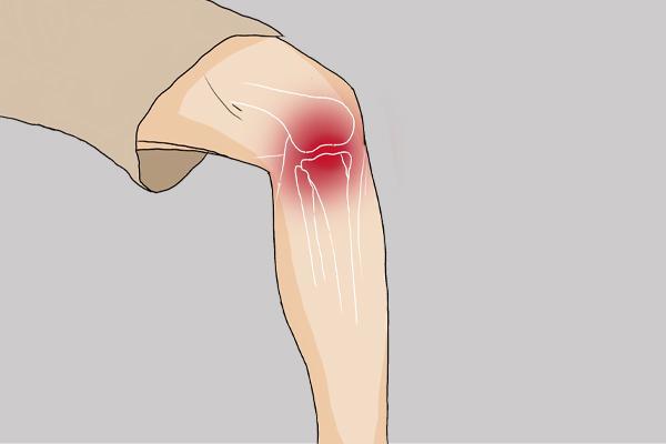 膝盖疼怎么办？可能是半月板损伤