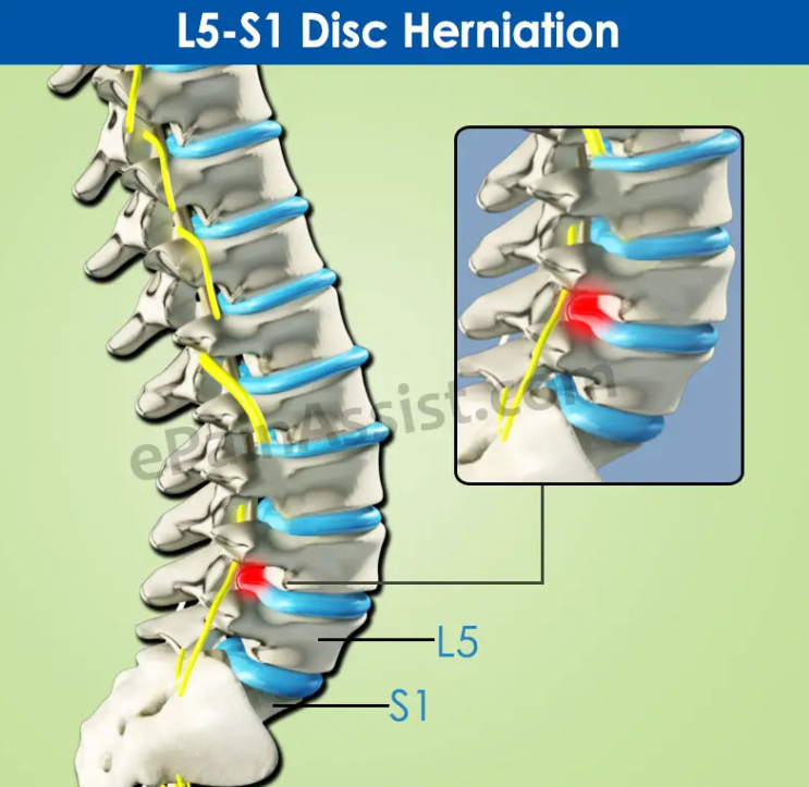 腰椎间盘突出能够自行恢复吗？分情况！