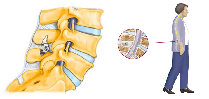 腰突怎么锻炼恢复