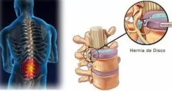 腰椎间盘突出症：远非简单的“腰疼”