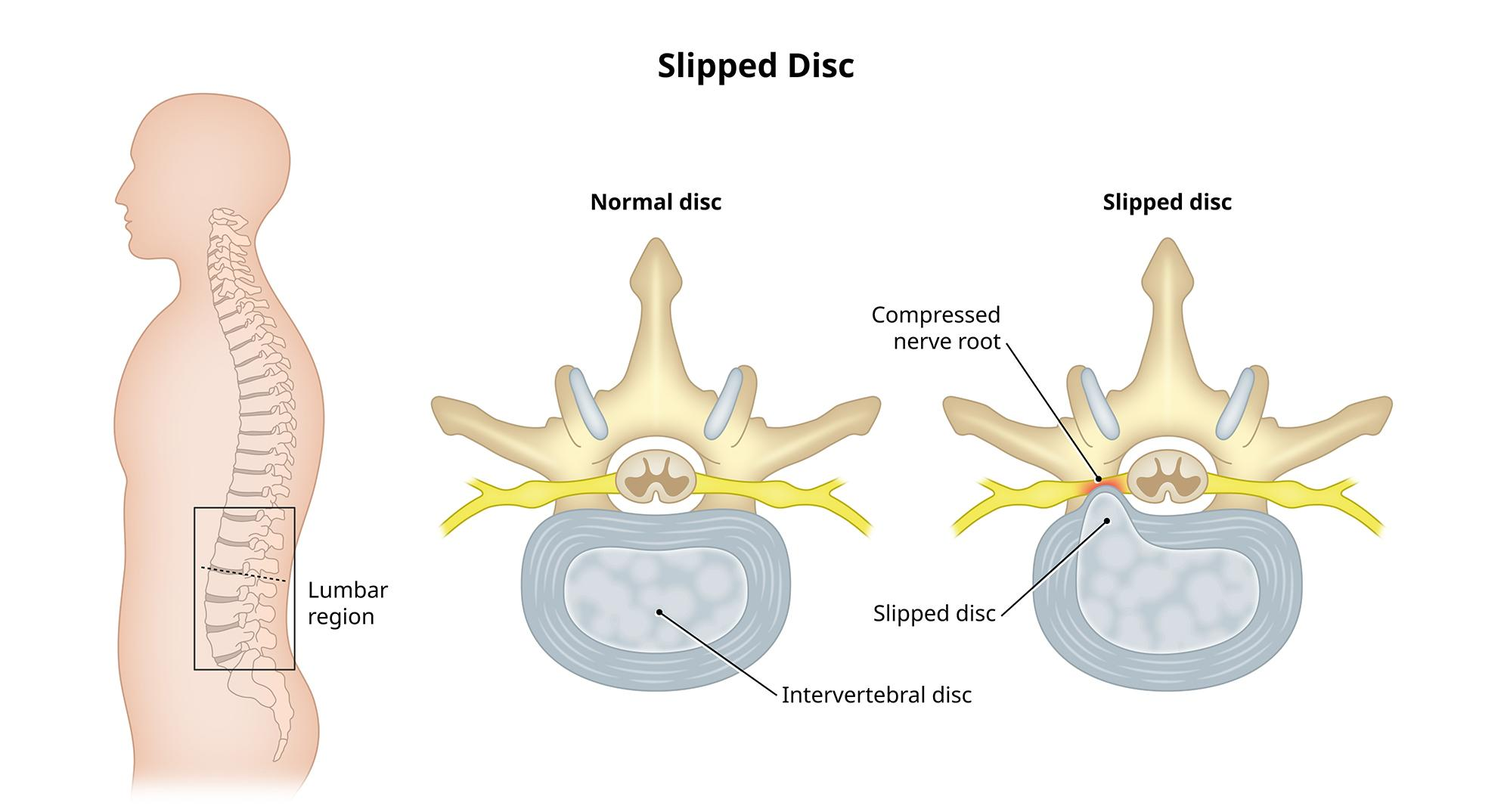 腰间盘突出为什么会导致腿麻脚疼呢？